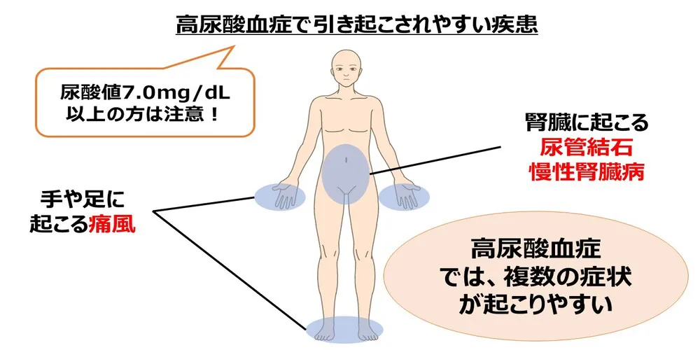 高尿酸血症で引き起こされやすい疾患画像