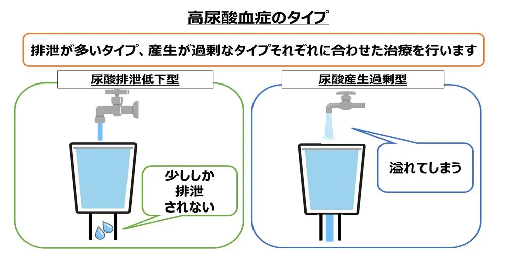 高尿酸血症のタイプ画像