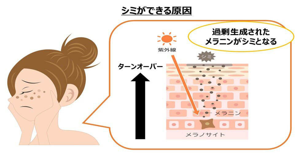 シミができる原因画像
