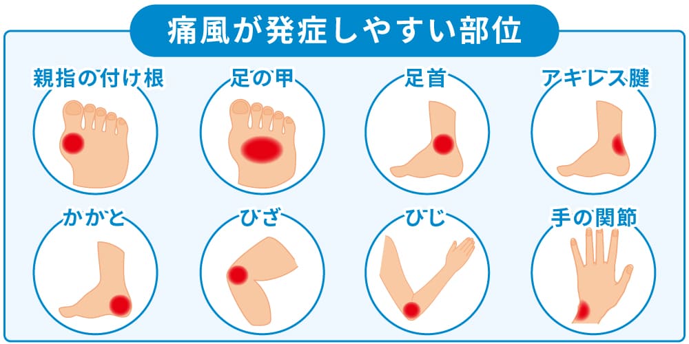 痛風が発症しやすい部位イメージ画像