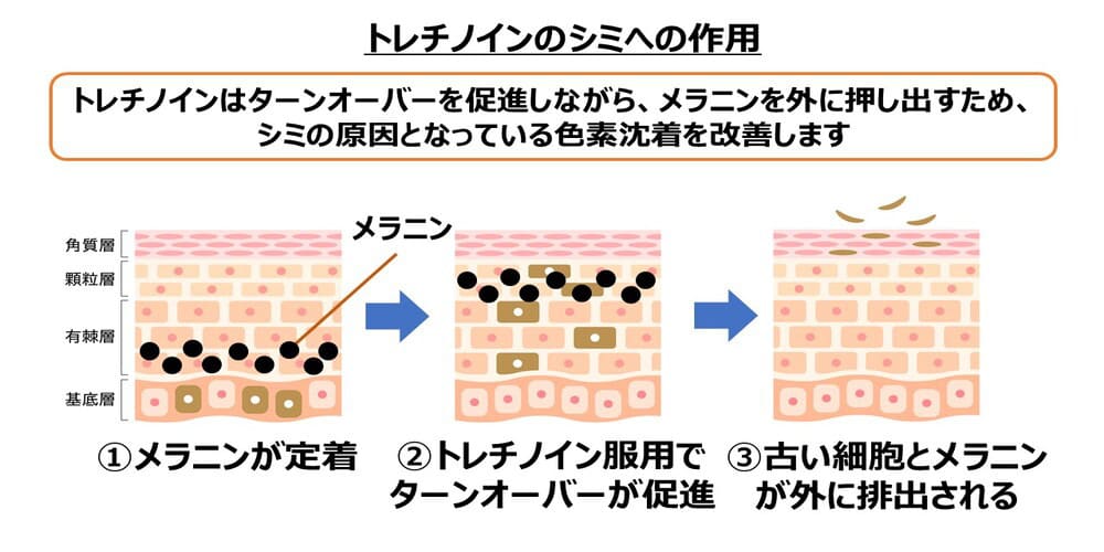 トレチノインのシミへの作用画像