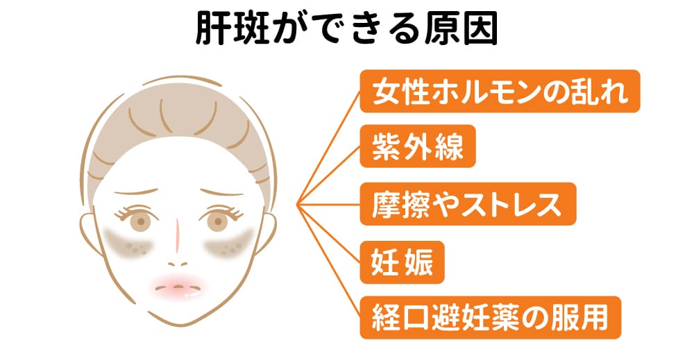 肝斑ができる原因画像