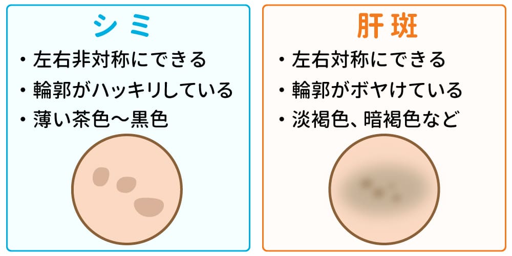 シミと肝斑の見分け方画像