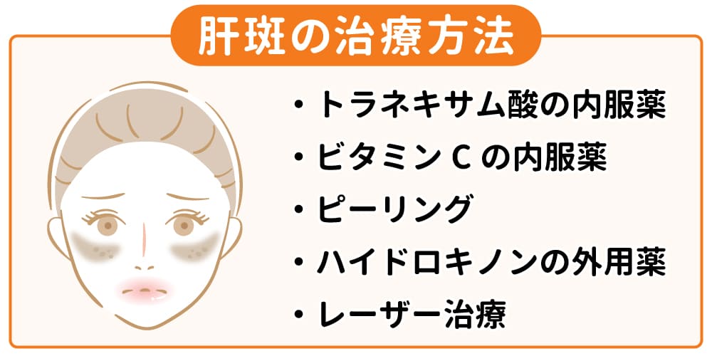 肝斑の治療方法画像