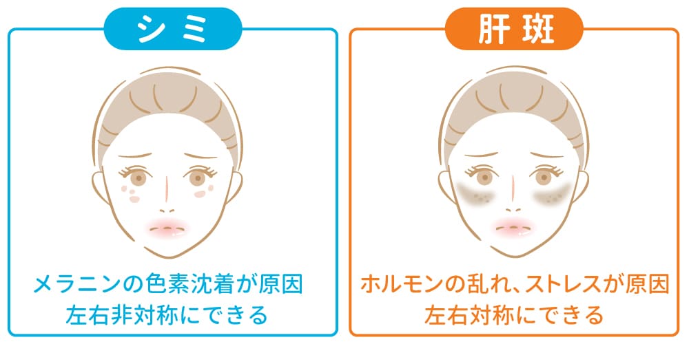 シミと肝斑の違い画像
