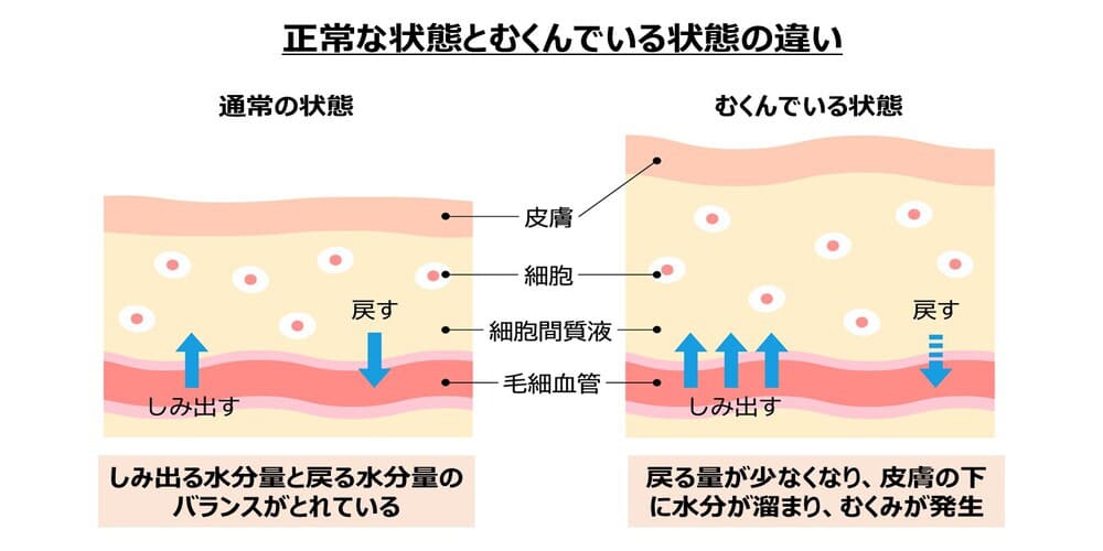 正常な状態とむくんでいる状態の違い画像
