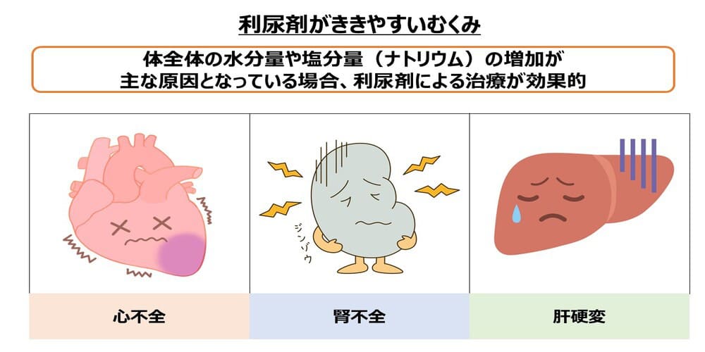利尿剤が効くむくみ画像
