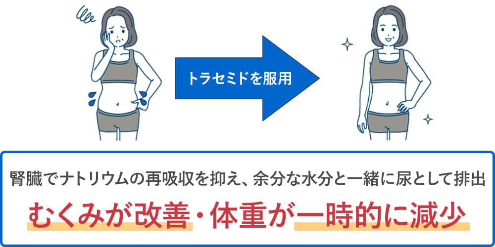 トラセミドによる水分排出のメカニズムと体重変化画像