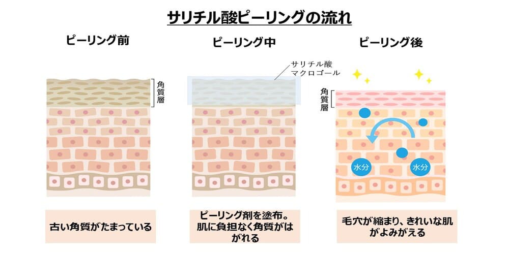 サリチル酸ピーリングの流れ