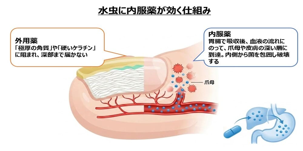 水虫に内服薬が効く仕組み画像