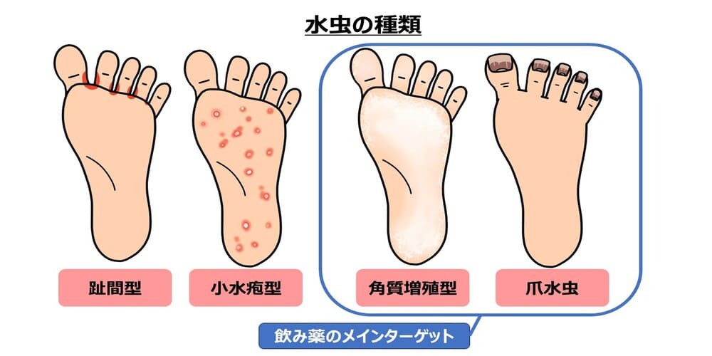 水虫の種類画像